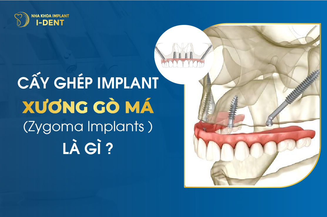 Cấy ghép Implant xương gò má (Zygoma Implants) là gì?