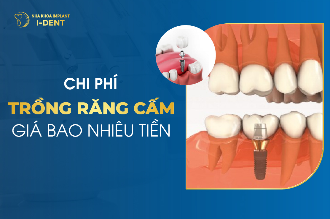 Trồng Răng Cấm Giá Bao Nhiêu? Chọn Phương Pháp Nào?