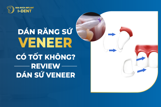 Dán Răng Sứ Veneer Có Tốt Không? Review Dán Sứ Veneer