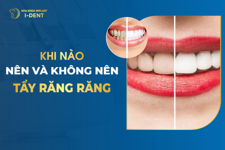 Có nên tẩy trắng răng không? Khi nào nên và không nên?