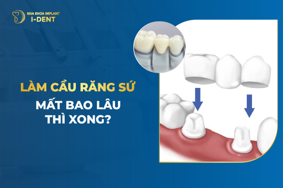 Làm răng sứ mất bao lâu? Bao lâu hồi phục bình thường?