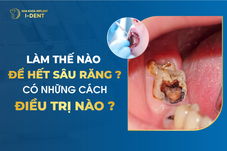 Bị sâu răng làm sao nhanh hết? Cách trị sâu răng triệt để