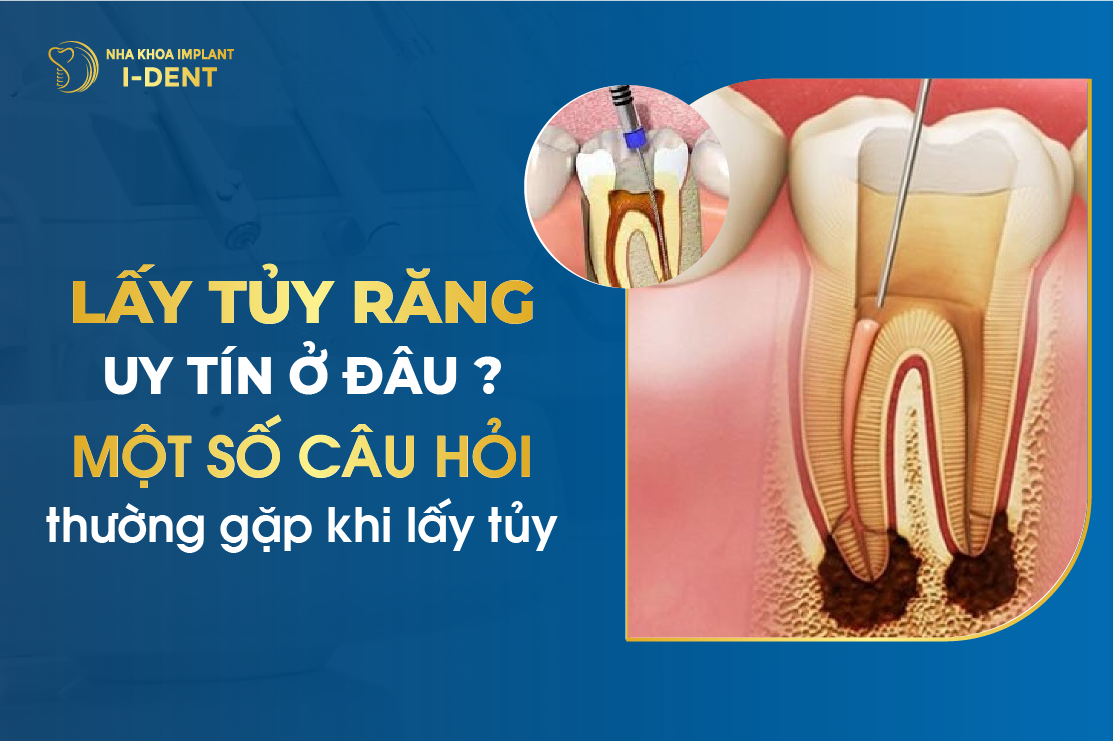 Địa Chỉ Chữa Tủy Răng Tại TPHCM Uy Tín Và Giá Rẻ Nhất