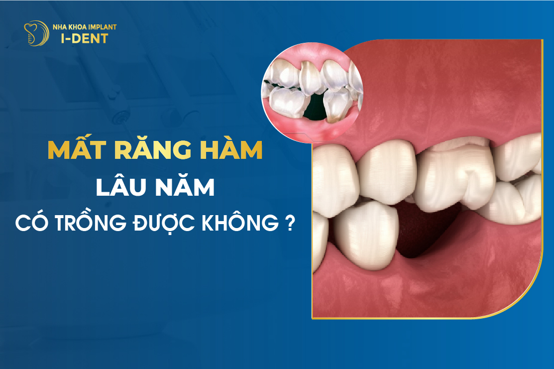 Mất răng lâu năm trồng được không? Phương pháp nào tốt?