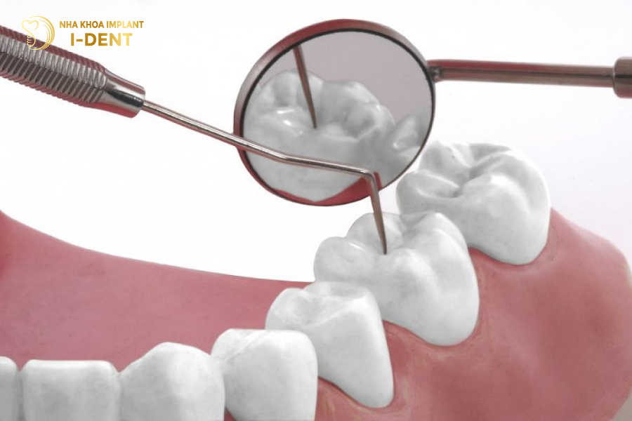 Miếng trám Composite đem lại tính thẩm mỹ cao