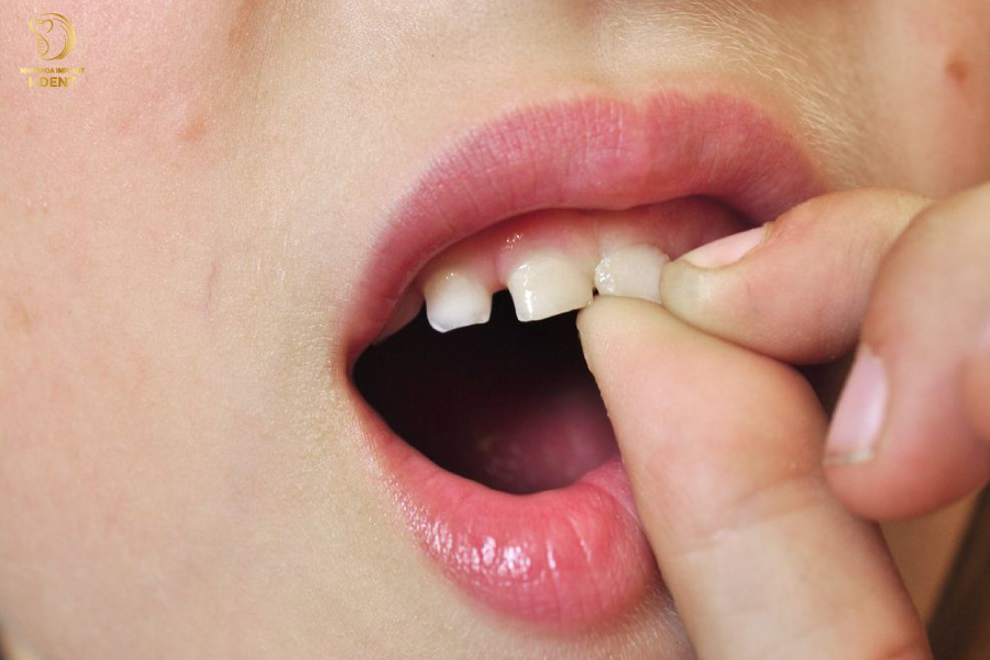 Răng bị lung lay nặng, không thể bảo tồn