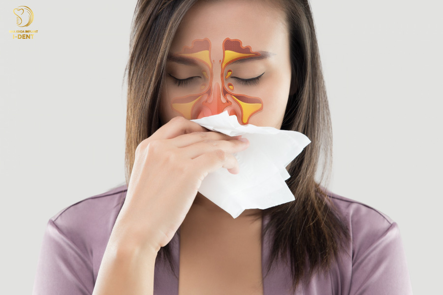 Viêm xoang cấp tính không nên nhổ các răng cối trên