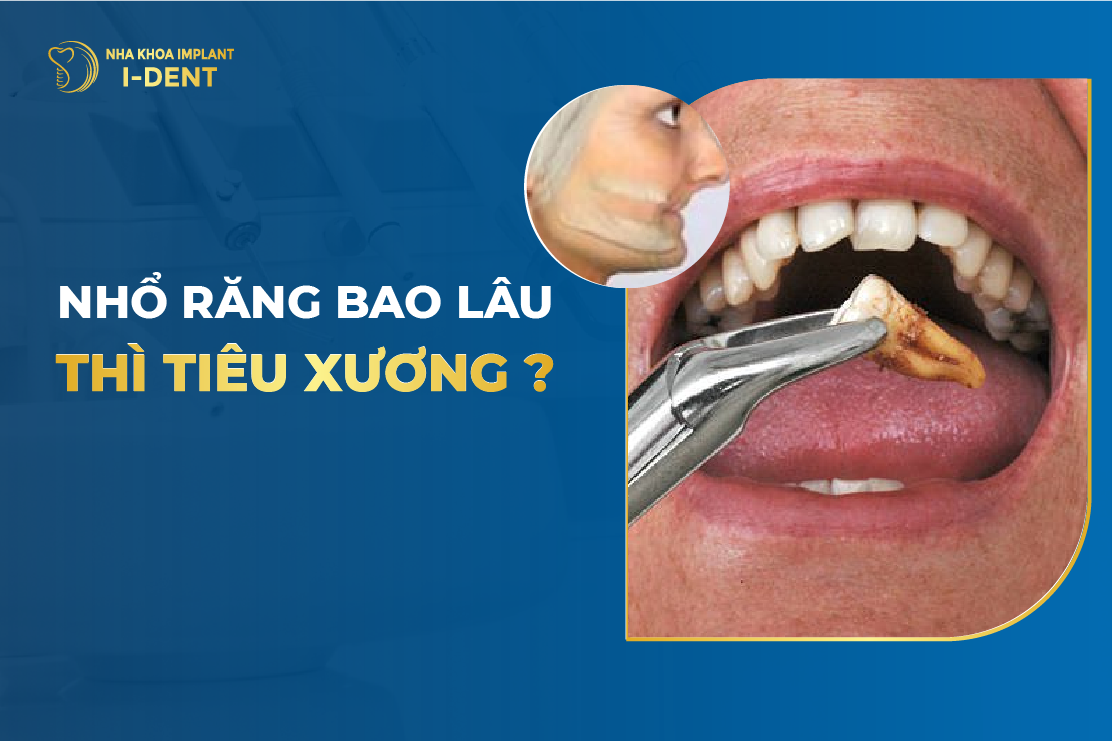 Mất răng bao lâu thì bị tiêu xương hàm? Cách phòng ngừa