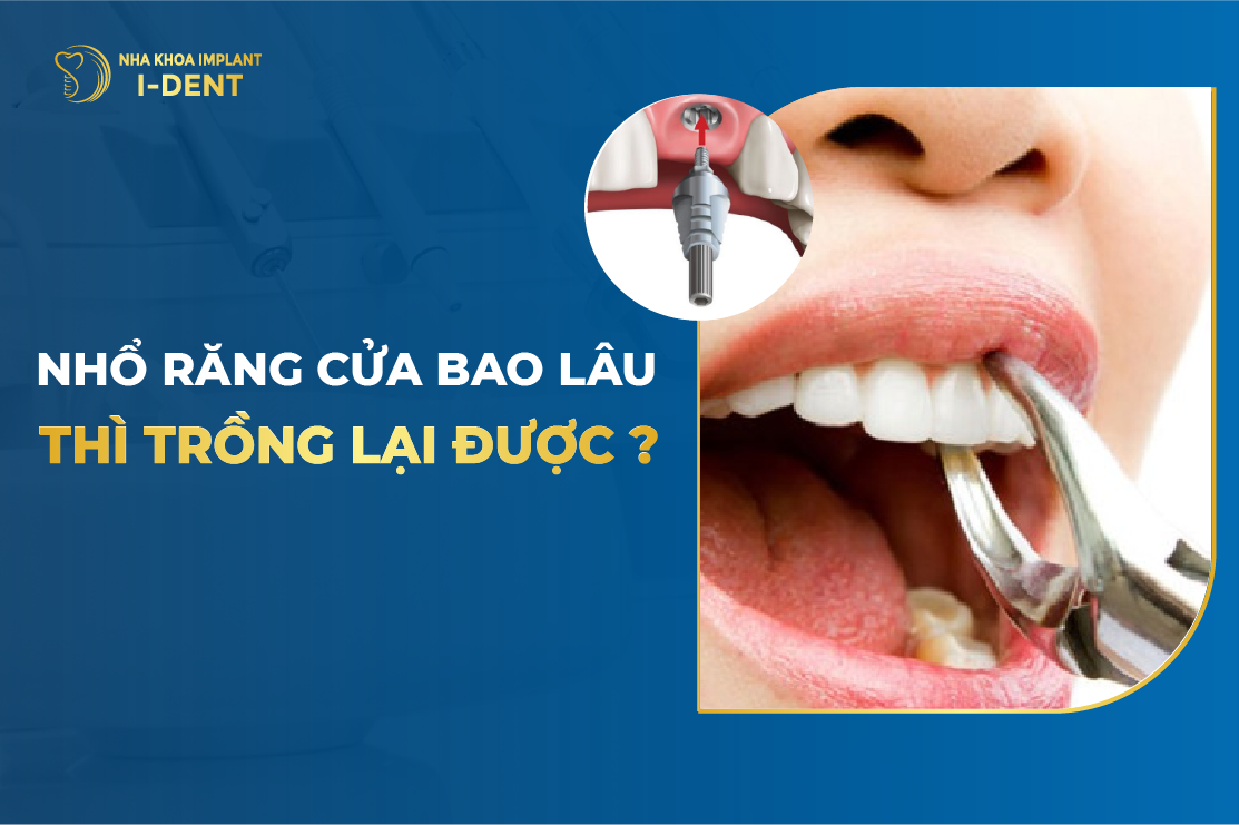 Nhổ răng bao lâu thì trồng lại được? Không trồng có sao không?