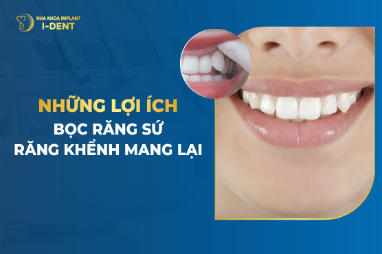 Bọc Sứ Răng Khểnh Được Không? Lợi Ích Bọc Răng Khểnh