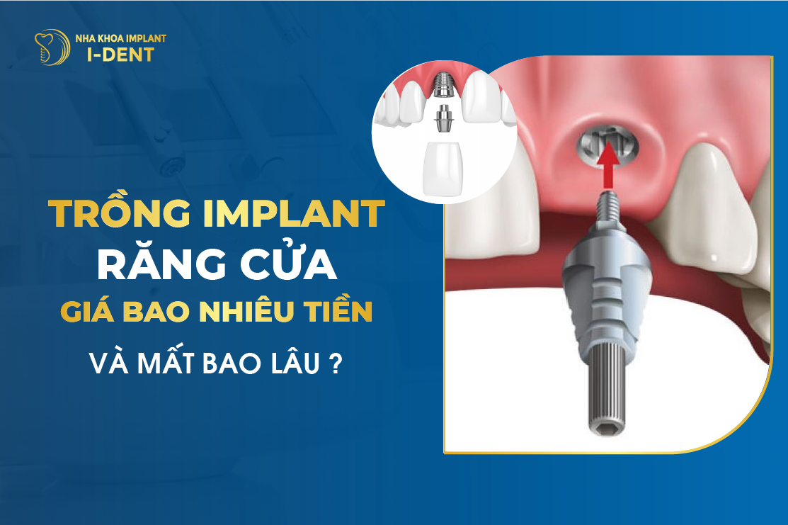 Giá trồng răng cửa bao nhiêu tiền?