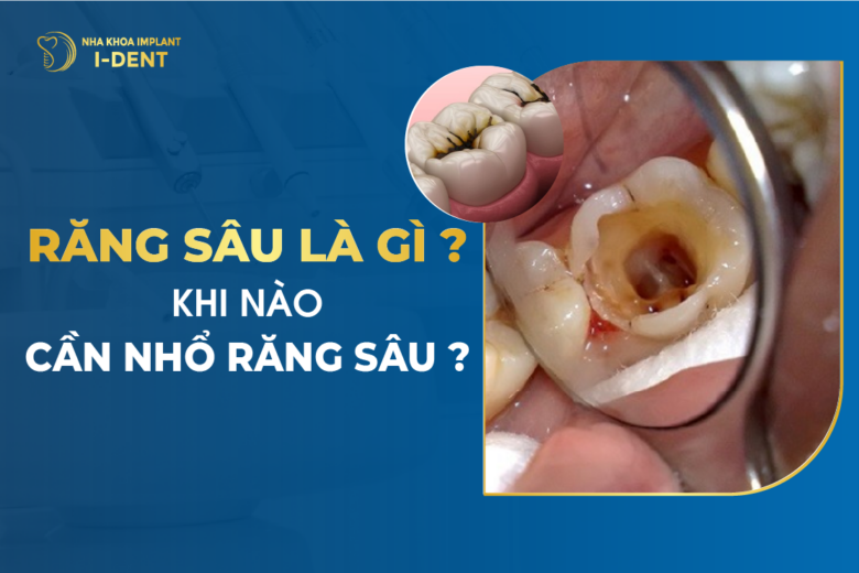 Nhổ răng sâu: Khi nào nên nhổ? Quy trình, chi phí và lưu ý