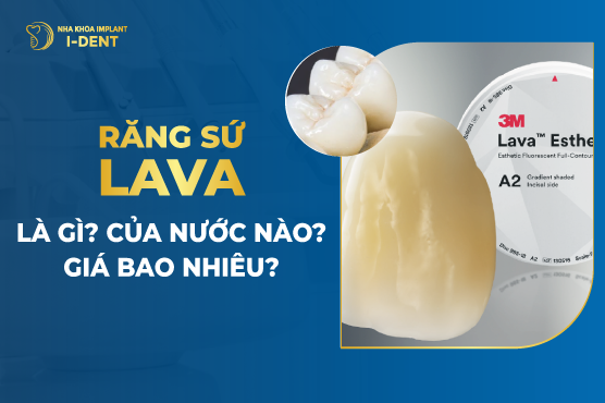 Răng Sứ Lava Là Gì? Của Nước Nào? Có Mấy Loại? Có Tốt Không?
