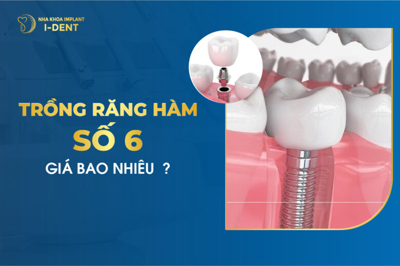 Trồng răng hàm số 6 giá bao nhiêu? Bảng giá mới nhất