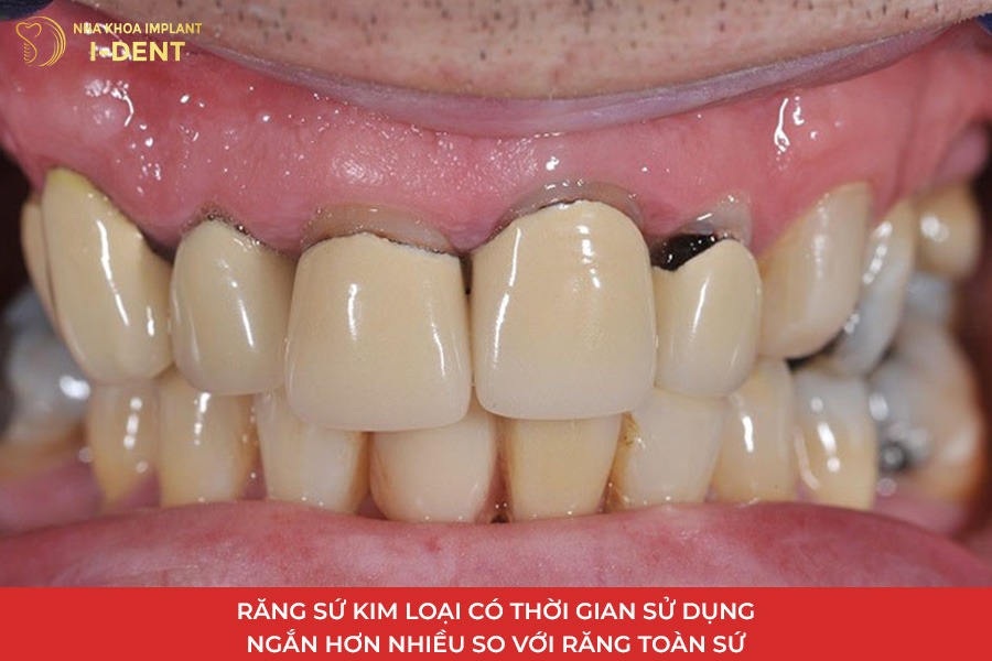 Răng sứ kim loại có tuổi thọ ngắn hơn so với răng toàn sứ.