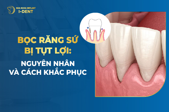 Làm răng sứ bị tụt lợi: Nguyên nhân và cách khắc phục