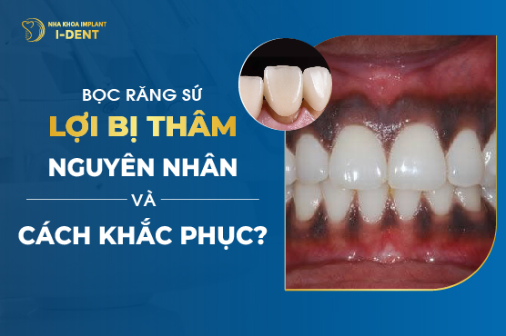 Bọc Răng Sứ Lợi Bị Thâm Nguyên Nhân Và Cách Khắc Phục?