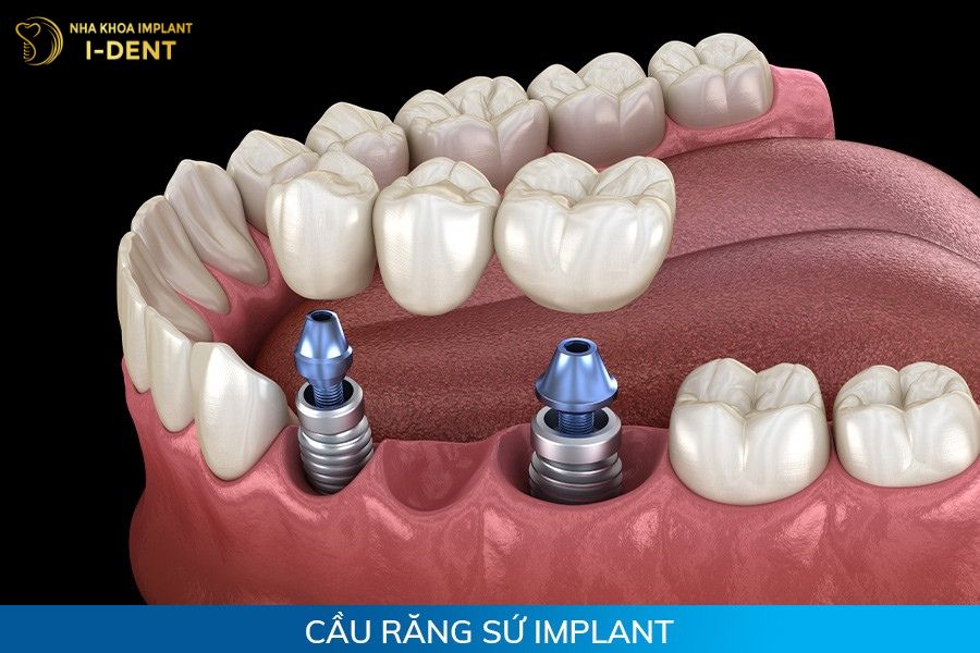cầu sứ