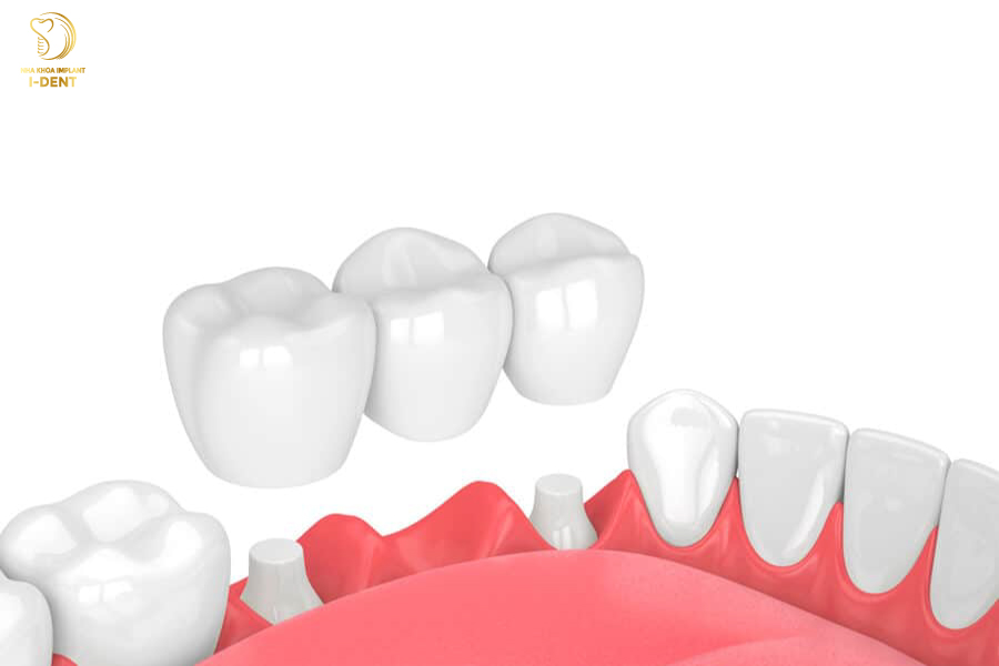 Làm cầu răng sứ gây tụt nướu