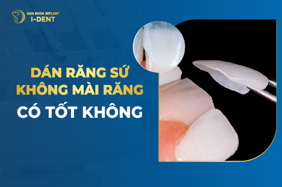 Dán Răng Sứ Có Phải Mài Răng Không? Ưu Nhược Điểm