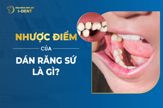 Ưu Nhược Điểm Của Dán Sứ Veneer Là Gì? Veneer Có Tốt Không?