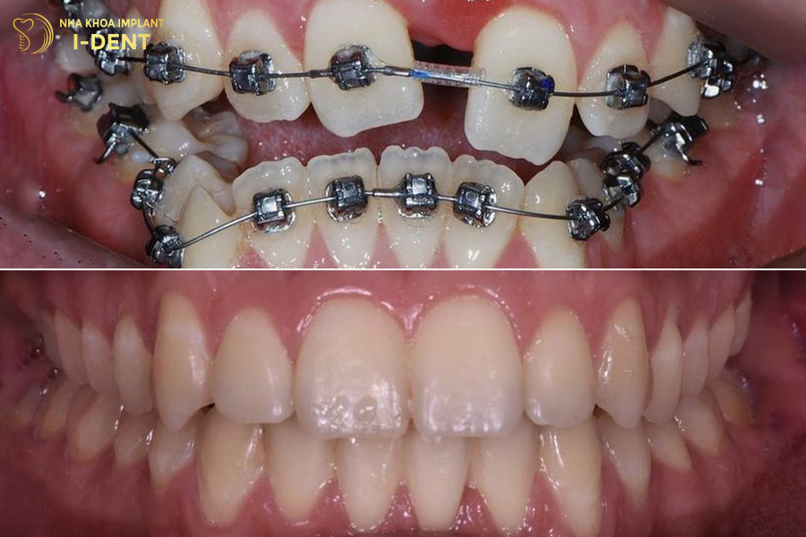Răng lộn xộn nặng nên niềng răng vì sẽ mang lại hiệu quả thẩm mỹ tối ưu và điều chỉnh được khớp cắn.