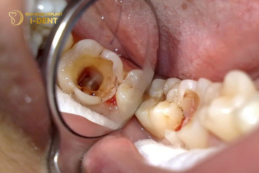 Răng bị viêm tuỷ do miếng trám răng không còn tác dụng