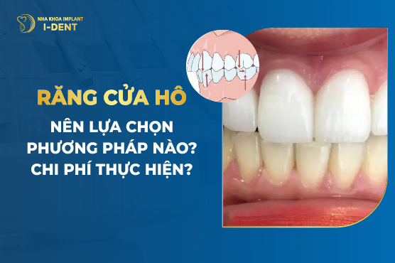 Răng cửa hô nên lựa chọn phương pháp nào? Chi phí thực hiện?