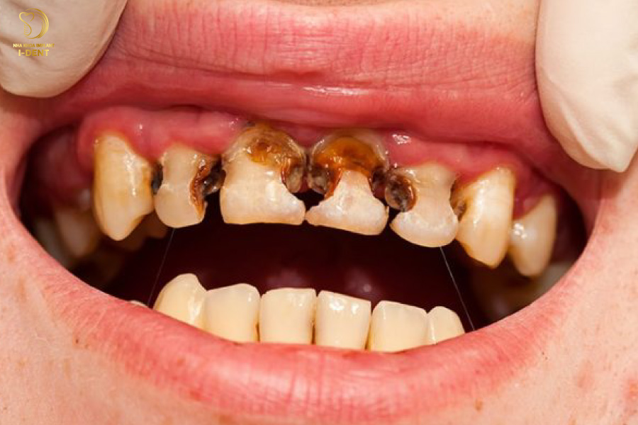 Phần thân và chân răng bị hư tổn nặng, không thể điều trị cần phải nhổ bỏ