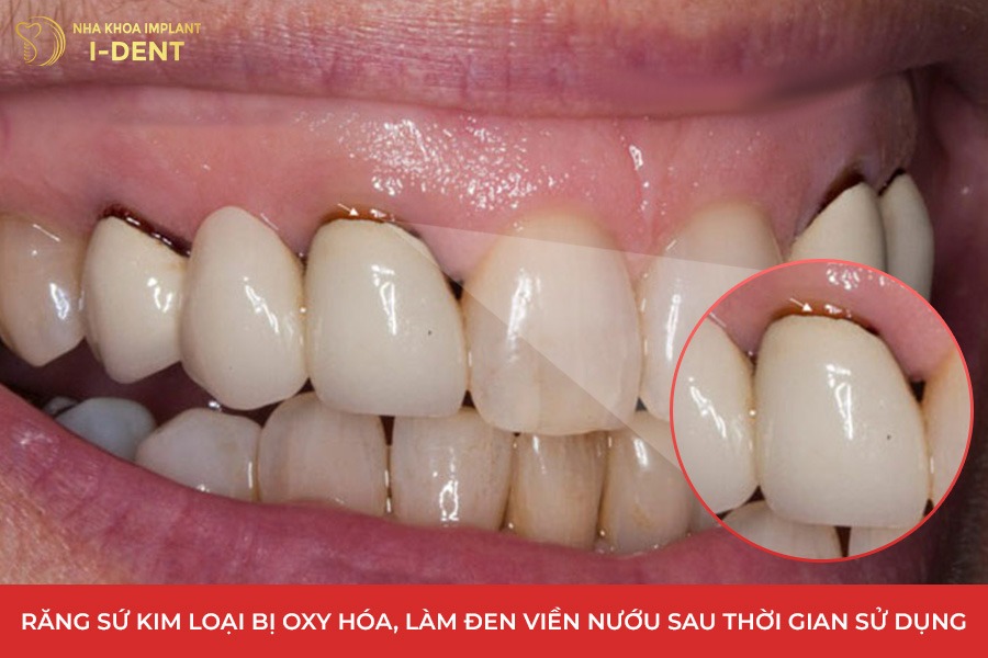 Răng sứ kim loại làm đen viền nướu sau thời gian sử dụng.