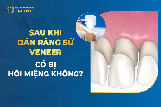 Sau Khi Dán Răng Sứ Veneer Có Bị Hôi Miệng Không?