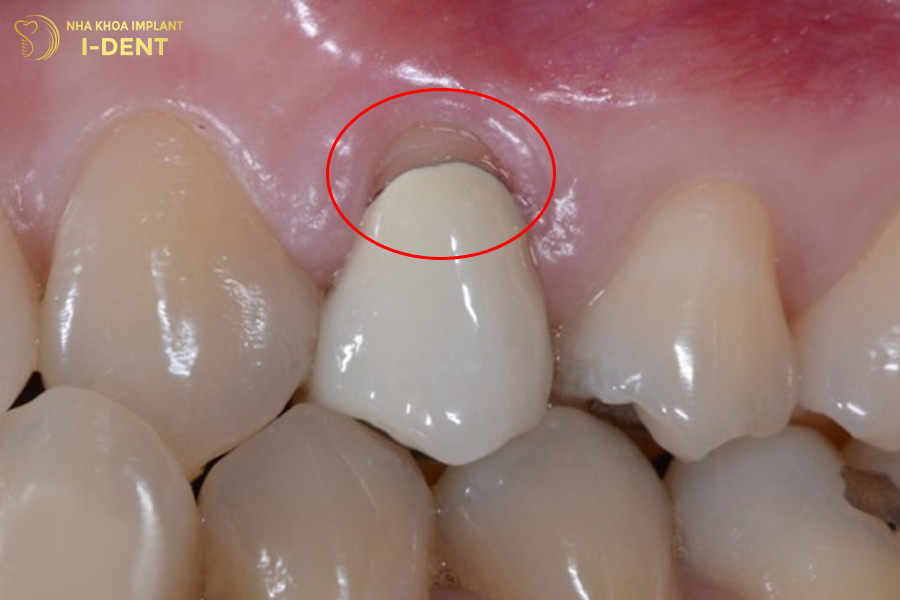 Tình trạng răng sứ bị hở làm lộ phần cùi răng bên trong.