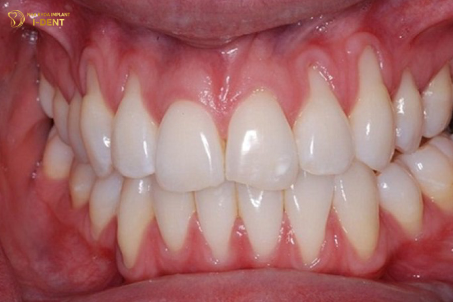 Tình trạng tụt nướu làm lộ chân răng