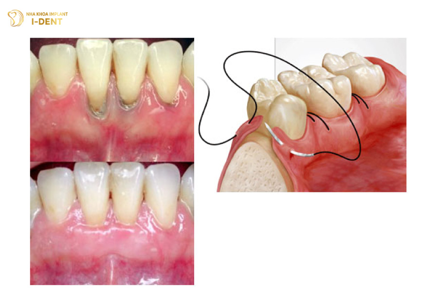 Tình trạng tụt nướu sẽ được khắc phục sau phẫu thuật tạo tình nướu