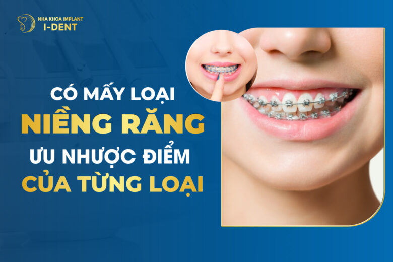 Các Loại Niềng Răng Phổ Biến Hiện Nay
