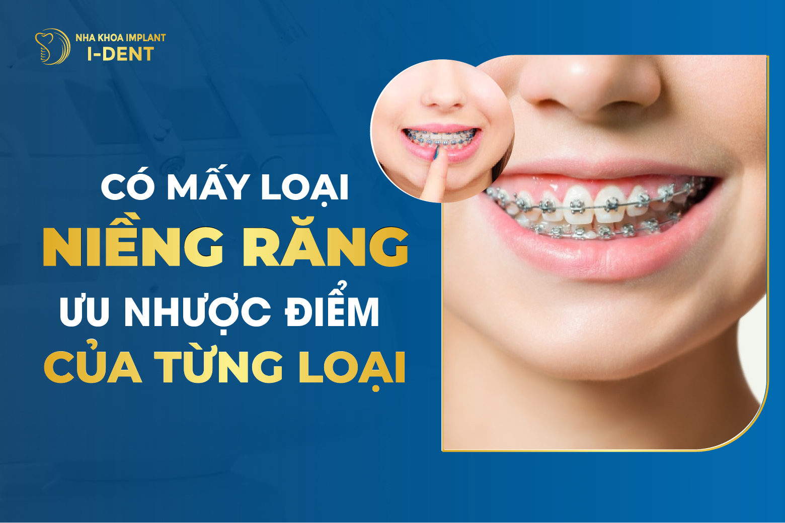 Các Loại Niềng Răng Phổ Biến Hiện Nay