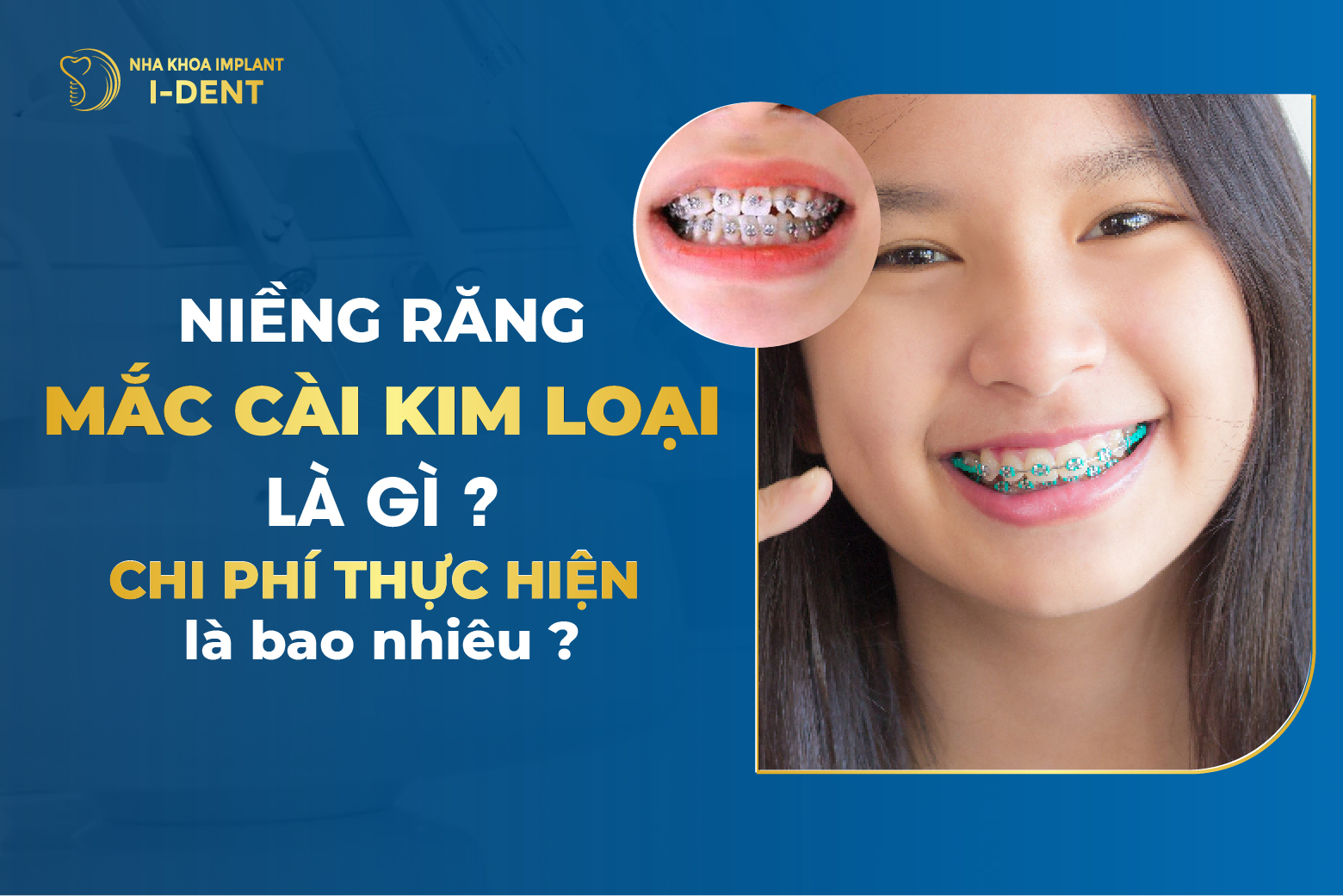 [T5/2026] Niềng răng mắc cài kim loại giá bao nhiêu?