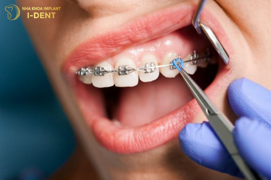 Bác sĩ kéo siết răng không đều sẽ dẫn tới nguy cơ hóp má khi niềng răng