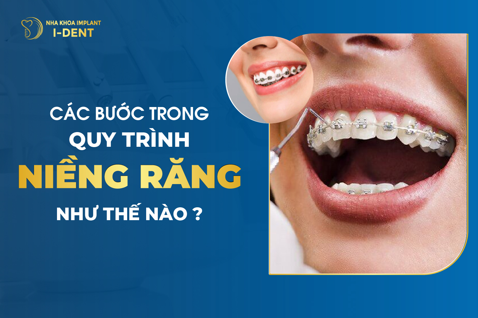 Quy Trình Niềng Răng Có Mấy Bước? Diễn Ra Như Thế Nào?