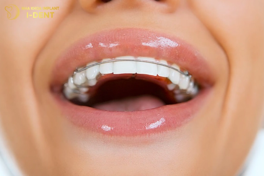 Nên đeo hàm duy trì tối thiểu 6 tháng sau khi tháo niềng