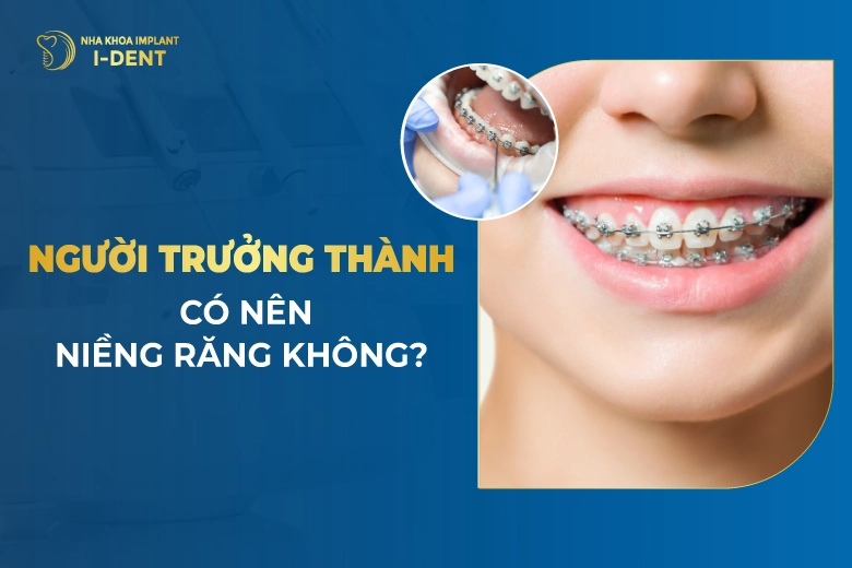 Có Nên Niềng Răng Không? Lợi Ích Và Phương Pháp
