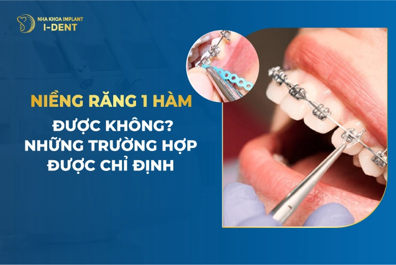 Niềng răng 1 hàm trên có được không? Hiệu quả, giá niềng