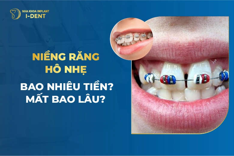 Niềng Răng Hô Là Gì? Lợi Ích, Phương Pháp Và Quy Trình