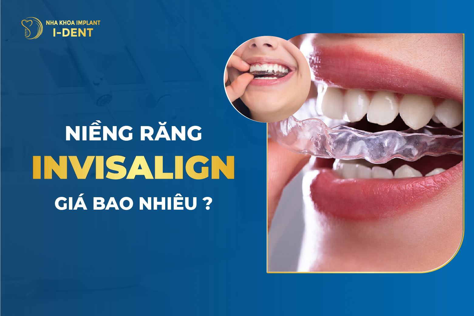 Giá Niềng Răng Invisalign Bao Nhiêu? Bảng Giá [T5/2026]