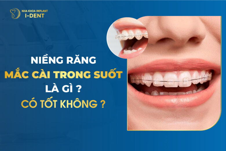 Niềng Răng Mắc Cài Trong Suốt Là Gì? Bao Nhiêu Tiền?