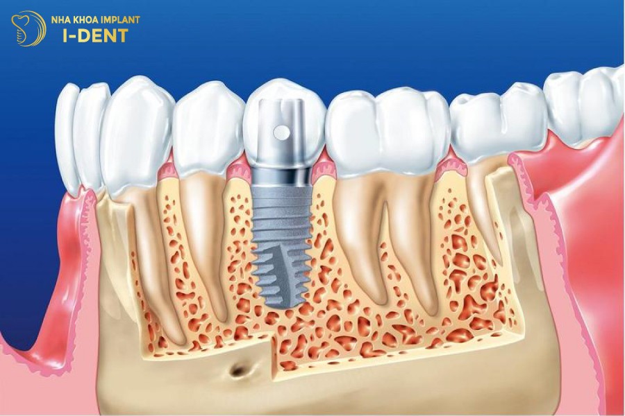 implant răng
