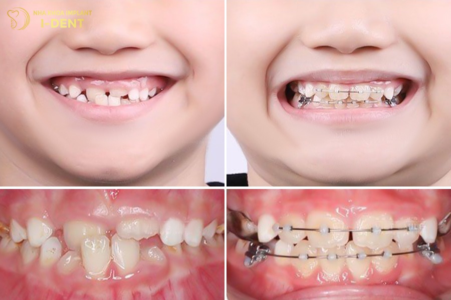 Độ tuổi niềng răng cho trẻ thích hợp từ 7-16 tuổi.
