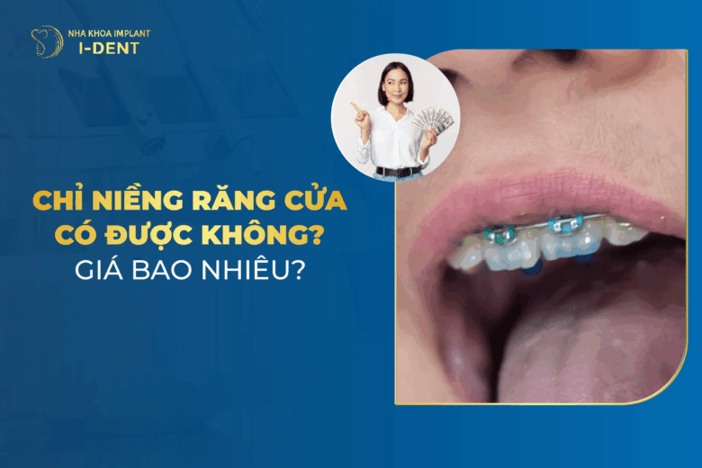 Niềng 2 Răng Cửa Giá Bao Nhiêu Tiền? Mất Bao Lâu?