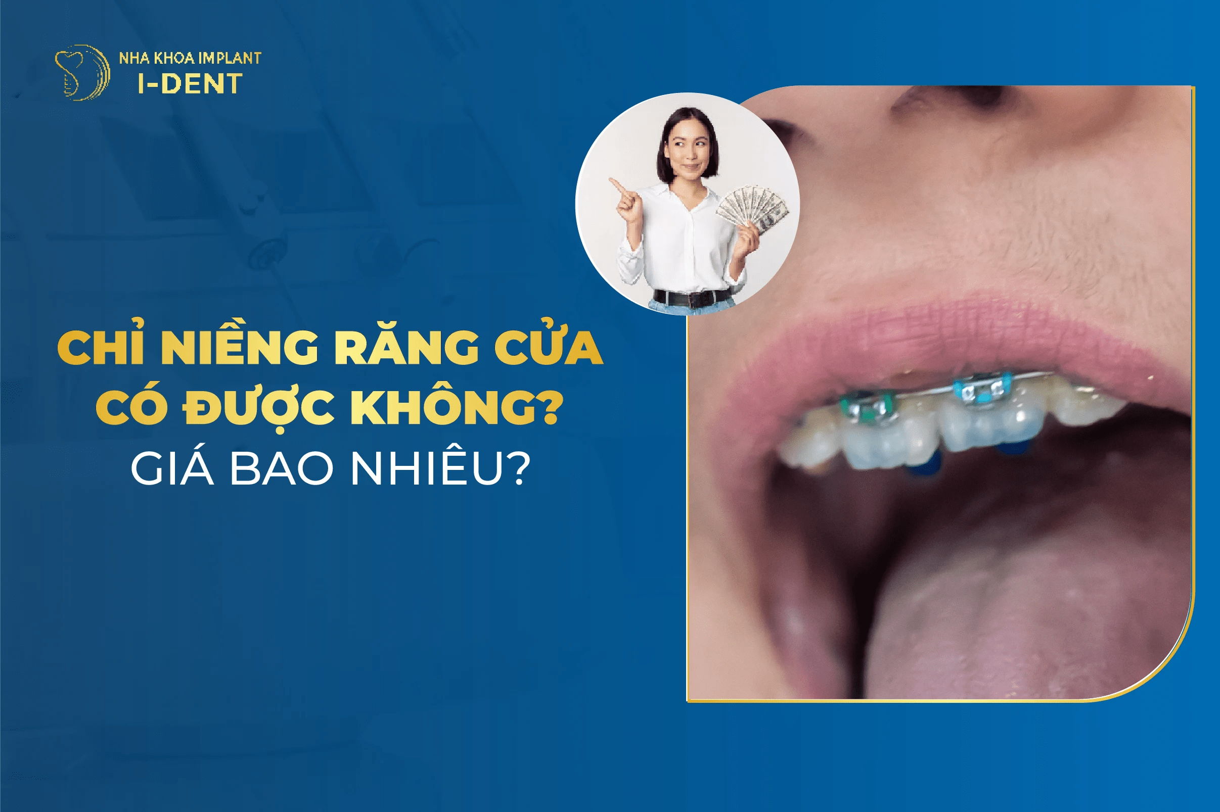 Niềng 2 Răng Cửa Giá Bao Nhiêu Tiền? Mất Bao Lâu?