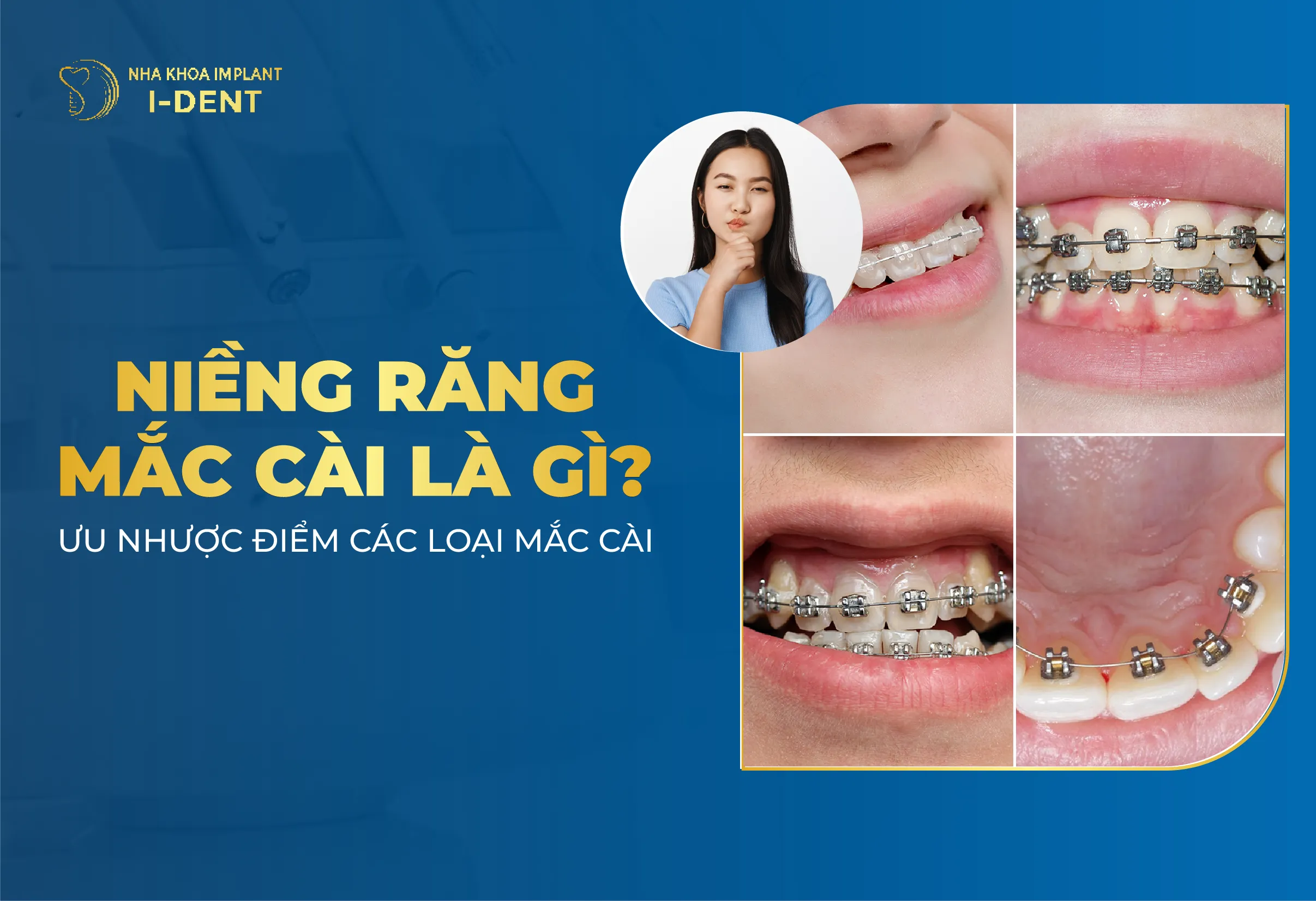 Niềng Răng Mắc Cài Là Gì? Ưu Nhược Điểm Các Loại? Giá Niềng